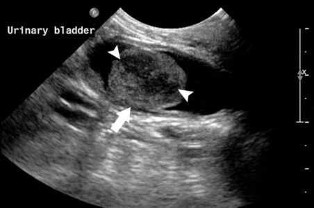 Bladder Ultrasound