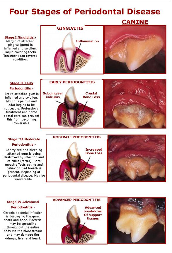 4 Stages of Perodontal disease